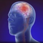 Terapia me oksigjen hiperbarik për pacientët me goditje në tru: Si funksionon?