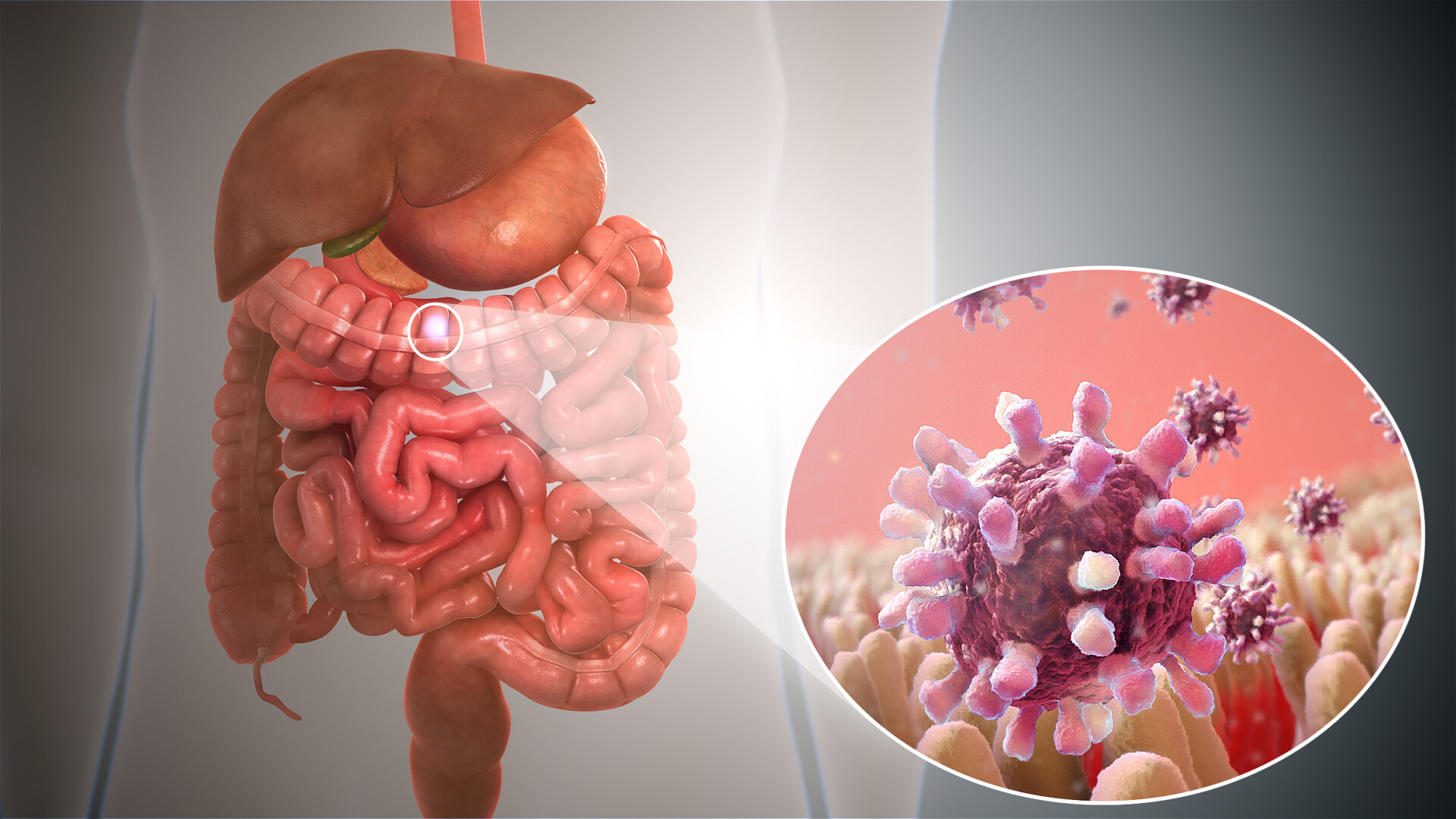 Çfarë është gastroenteriti viral ose gripi i stomakut?